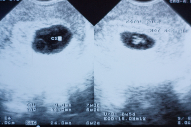 ecografia-gravidanza-shutterstock_144462814